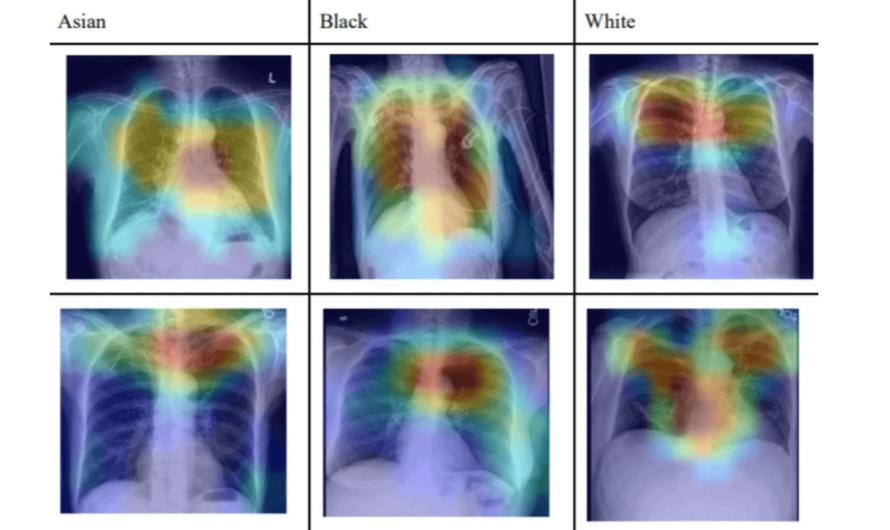 Искусственный интеллект научился распознавать расу по медицинским снимкам