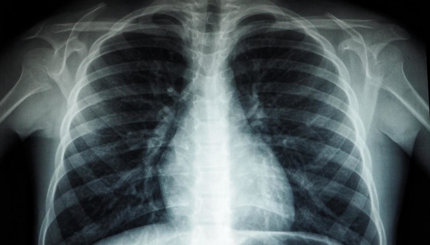 Active Pulmonary Tuberculosis Deep Learning Detection