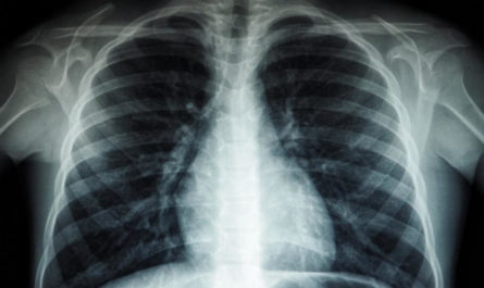 Active Pulmonary Tuberculosis Deep Learning Detection
