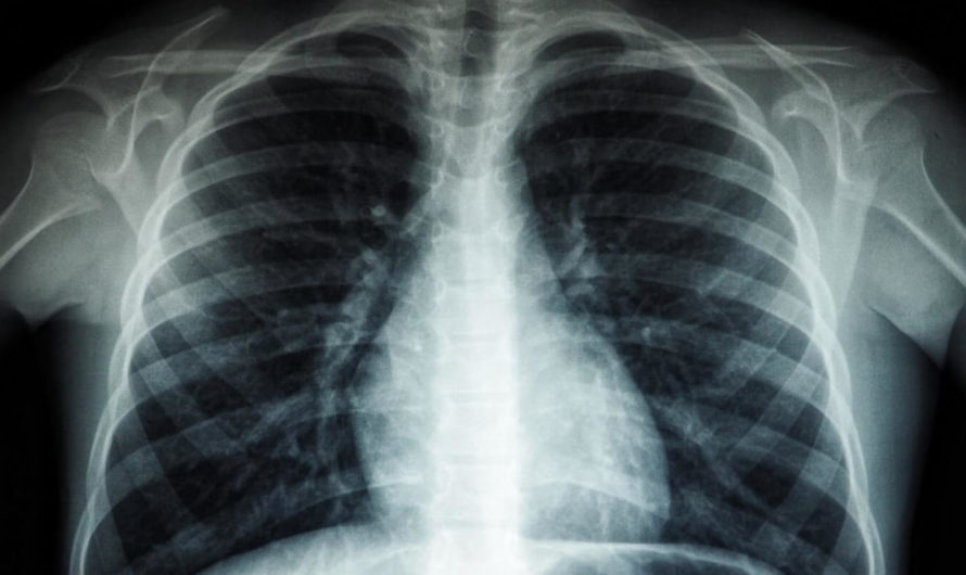 Искусственный интеллект научился выявлять туберкулёз не хуже врачей-рентгенологов